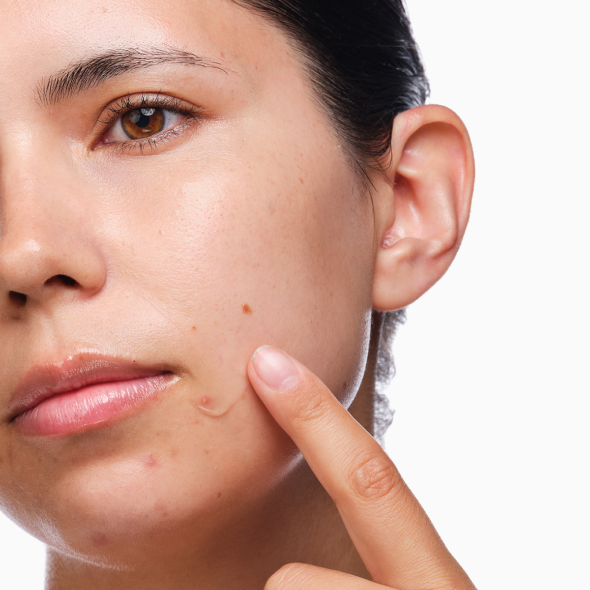 the-acne-set-t9 rdn-the-acne-set-application.png