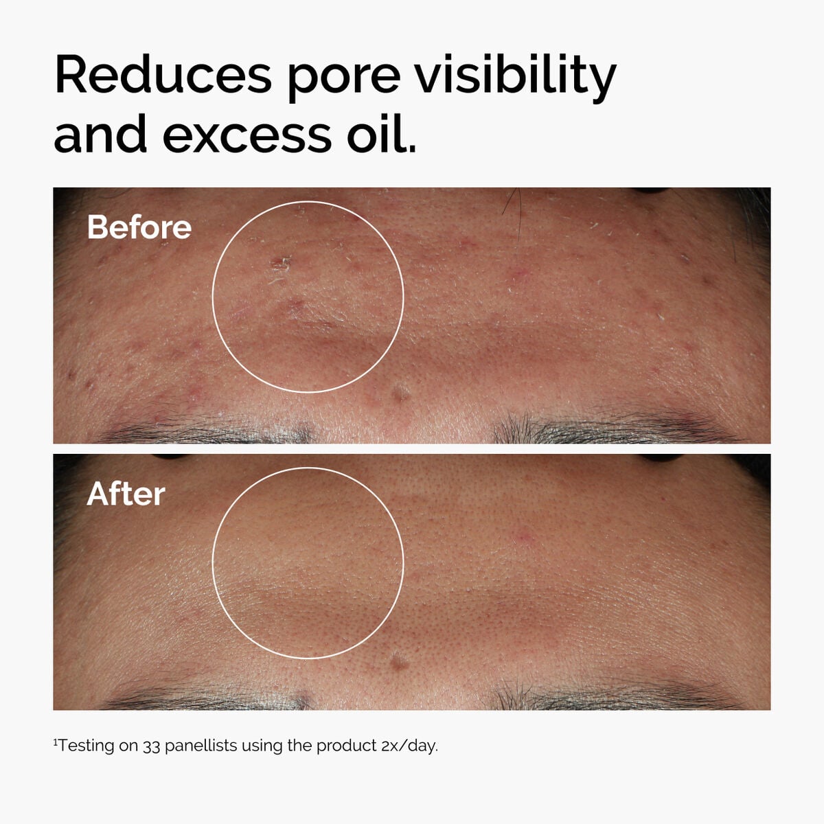 niacinamide-10-zinc-1-u0 ord-niacinamide-zinc-blemish-serum-before-after-pores.jpg