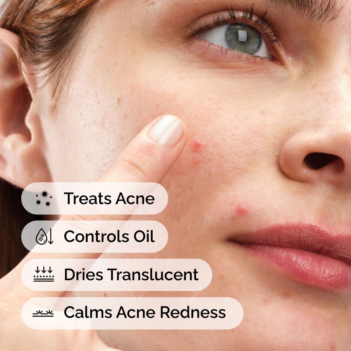sulfur-10-powder-to-cream-concentrate-u7 ord-sulfur-10pct-powder-to-cream-concentrate-model-application-with-benefits-acne.jpg